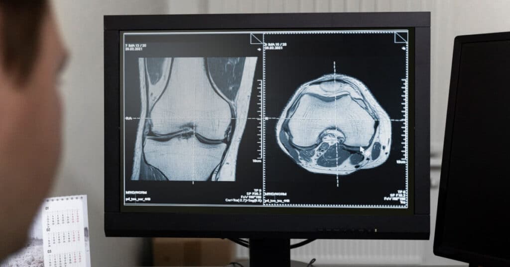 Medical monitor showing knee MRI scans: sagittal view on left and axial knee slice on right, with a blurred person in foreground